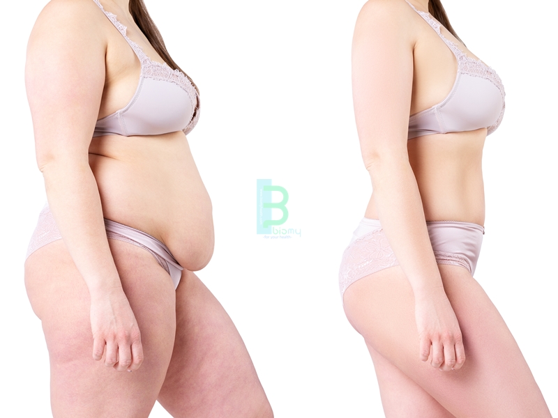 Obezite Tedavisi ve Öncesi Sonrası Fotoğrafları
