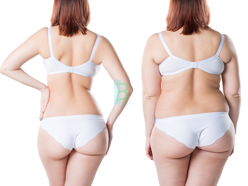Obezite Tedavisi ve Öncesi Sonrası Fotoğrafları