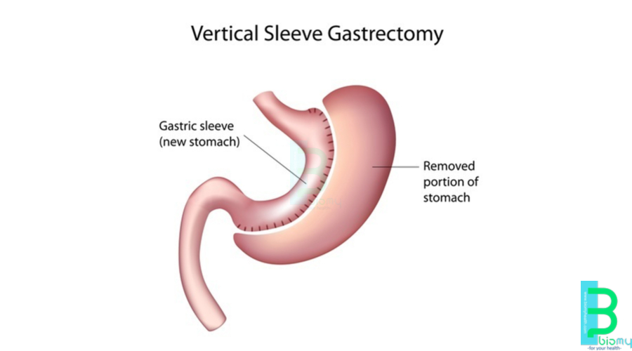 Tube Stomach Surgery Istanbul Turkey, With the Best Doctors (Sleeve Gastrectomy)